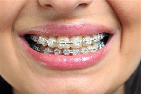 Things Your Orthodontist Wont Tell You The Healthy