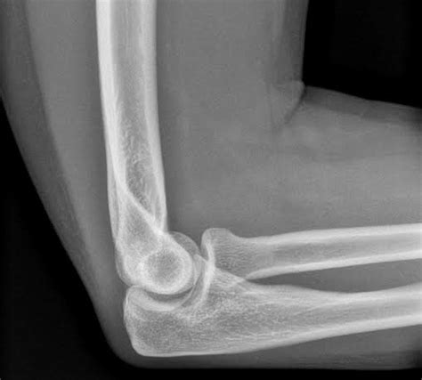 Medial Ulnar Collateral Ligament Injury Shoulder Elbow Orthobullets