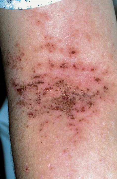 Dermatitis And The Newborn Rash Of Hyper Ige Syndrome Dermatology