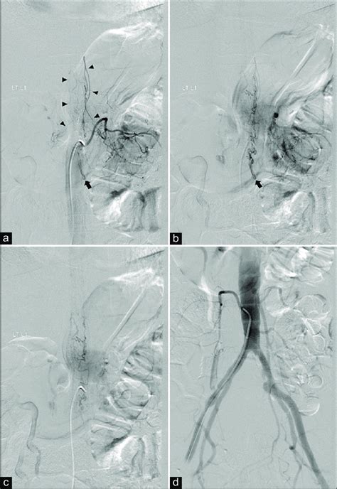 Anteroposterior Views Of The Left L1 Segmental Artery Angiography In