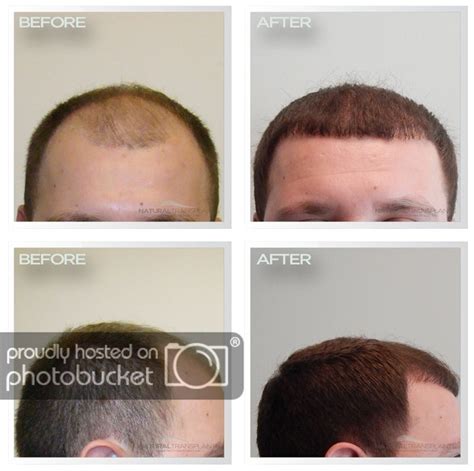 Natural Transplants Hair Restoration Clinic Towson On Twitter Hair