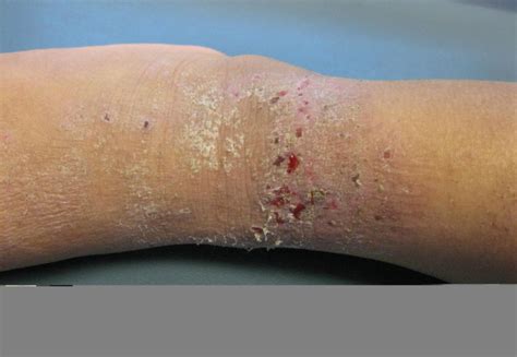 Atopic Dermatitis Atopic Eczema Pulmonology Advisor