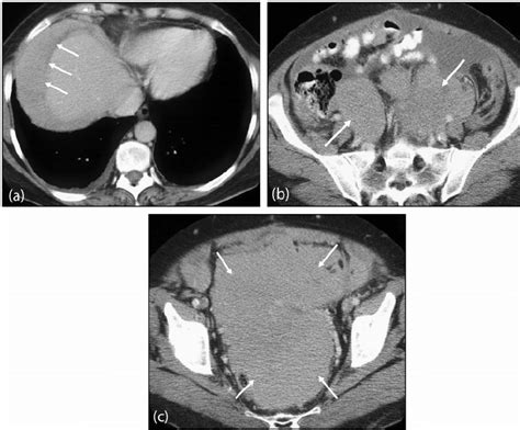 Malignant Peritoneal Mesothelioma A Contrast Enhanced Axial Ct Of