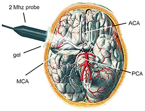 Frontiers Transcranial Doppler Ultrasonography As A Diagnostic Tool