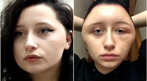 Near Fatal Allergic Reaction To Hair Dye Transforms French Woman S Head Into Light Bulb