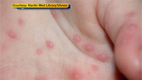 university of illinois reports 60 cases of hand foot and mouth disease abc7 chicago