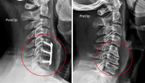 Anterior Cervical Discectomy And Fusion Acdf Manhattan Spine Images And Photos Finder