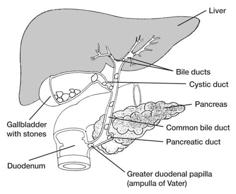 Biliary Tract With Stones In The Gallbladder And Common Bile Duct With