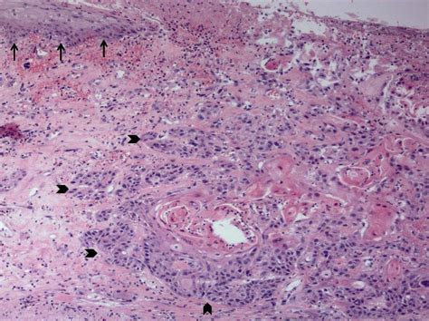 Invasive Scc Of The Esophagus Showing Normal Squamous Mucosa In The