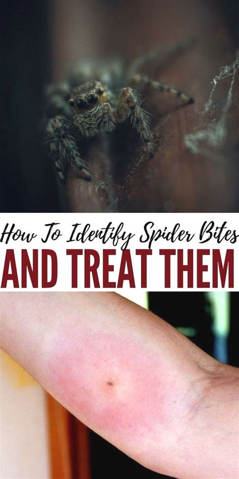 Pin By Lanenjjxas On Home Remedies Spider Bites Survival Survival Tips