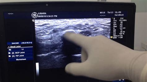 Cervical Rib Dx By Ultrasound Youtube