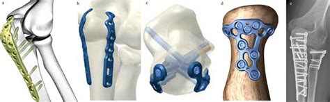 Olecranon Management Of Type Iib And Iiib Olecranon Fractures Case