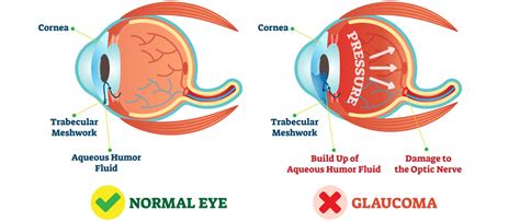 Newly Diagnosed With Glaucoma Here Are Some Treatment Options Eye Doctors Eye Exams In