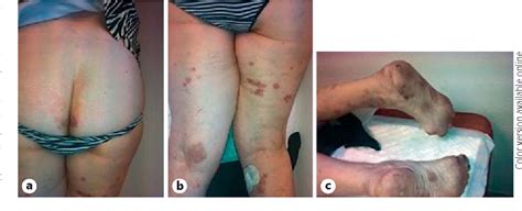 Get Rheumatoid Arthritis Rash Images - Propranolols