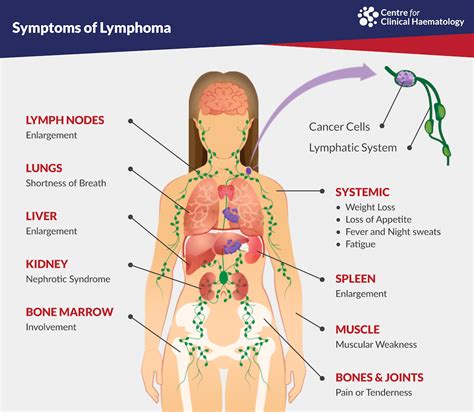 Lymphoma Signs Diagnosis Treatments In Singapore