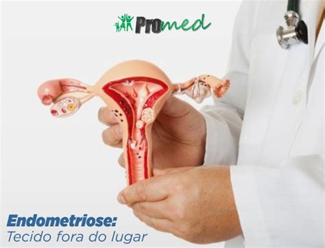 Bei endometriose treten zysten und entzündungen weil endometriose sich ganz unterschiedlich zeigen kann, ist sowohl die diagnose als auch die behandlung schwierig. Endometriose | Promed Macapá
