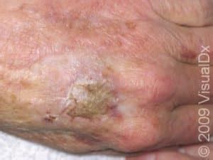 Actinic Keratosis Solar Keratosis Condition Treatments And Pictures For Adults Skinsight