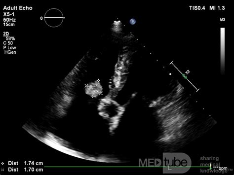 Endocardite Infectieuse De La Valve Tricuspide • Image • Site Médical