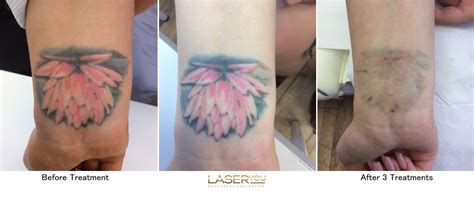 Laser Tattoo Removal Using Picosure Laseryou Picosure Tattoo Removal