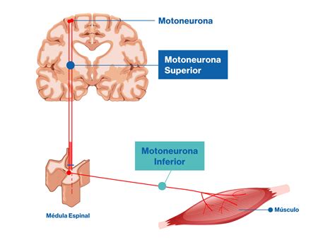 Presentación de un caso presuntivo y revisión. Atrofia Muscular Espinal | Novartis