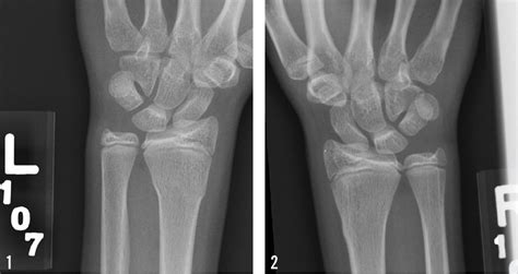 A 14 Year Old Girl With A Weightlifting Injury Of The