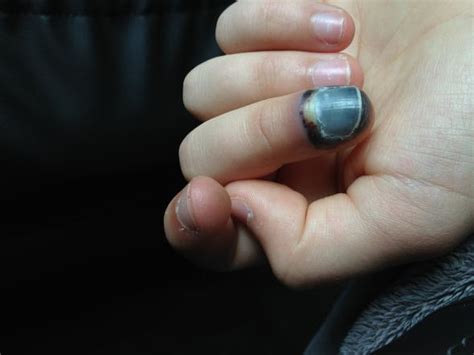 Symptome eine prellung des fingers macht sich üblicherweise schon direkt nach dem unfall oder der ursächlichen gewalteinwirkung durch starke schmerzen bemerkbar. Langsam schwarzer geschwollener finger (Arzt, Entzündung ...