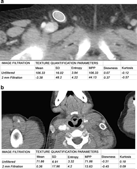 Axial Contrast Enhanced Ct Images Show Examples Of Benign A Right