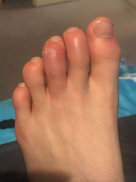 Covid Toes Mums Stark Warning To Parents After Sons Rare And Painful