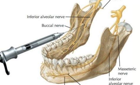 Inferior Alveolar Nerve Block Huji Studocu Odontologia Anatomia