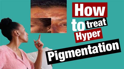 How To Treat Hyperpigmentation Hyperpigmentation Youtube