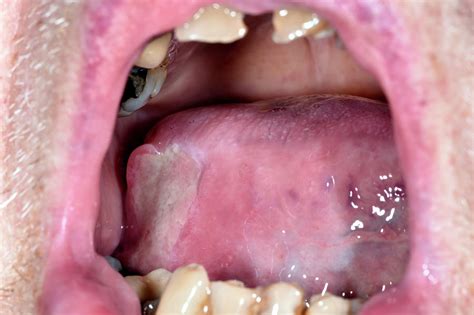 Canker Sore Photograph By Dr P Marazziscience Photo Library