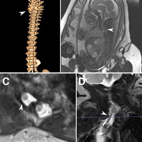 Spinal Imaging For Case 1 A 3d Reconstruction Of Ct Myelogram At Birth