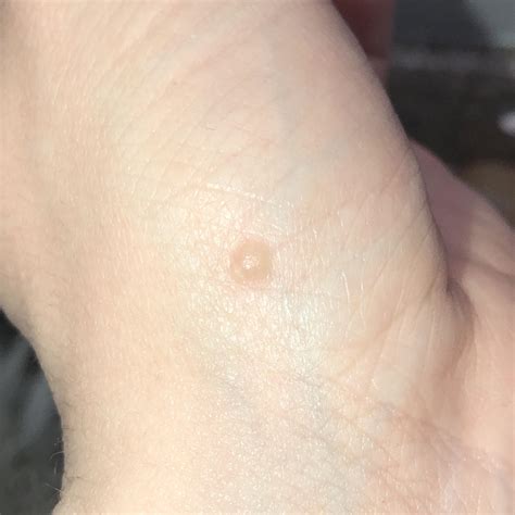 Itchy Bump On Palm Near Wrist This Is 24 Hours After Noticing Appears