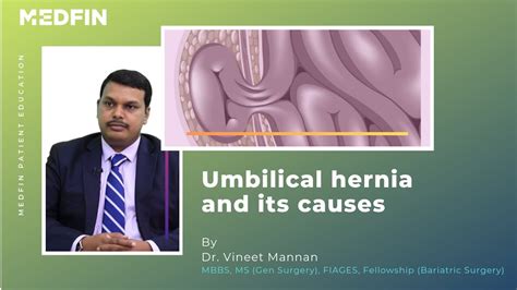 Umbilical Hernia Causes And Symptoms Youtube