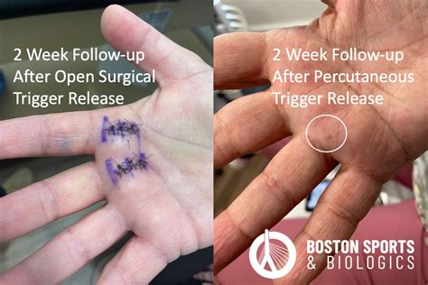 Boston Sports Trigger Finger Trigger Finger Release Trigger