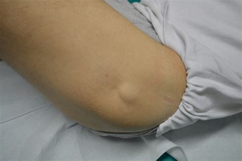 Lipoma sottocutaneo su schiena, collo, cisti, liposarcoma ...