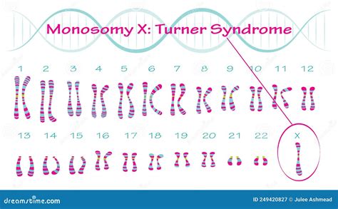 Monosomy X Turner Syndrome Karyotype Stock Vector Illustration Of