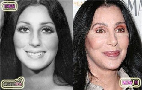 Cher With Bad Plastic Surgery Before After Pelis