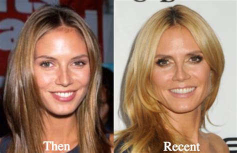 Heidi Klum Plastic Surgery Before And After Photos Latest Plastic