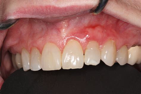 Gingival Grafting After Zionsville Dentist Darrin R Combs Dmd