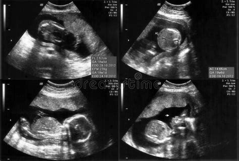 Ultrasound Of A Fetus At 20 Weeks Stock Photo Image Of Weeks