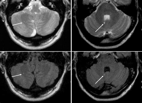 Brain Stem And Cerebellar Hyperintense Lesions In Migraine Stroke