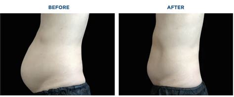 Why Emsculpt Neo Outshines Coolsculpting The Ultimate Body Contouring