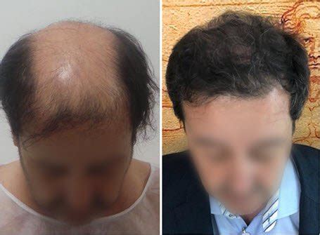 — in your brush or the shower. New solution to baldness, hair loss, regrows it naturally ...