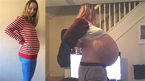 elle pensait être enceinte mais elle avait un kyste de 26 kilos dans le ventre