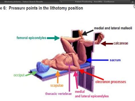 Lithotomy Position By Neila E