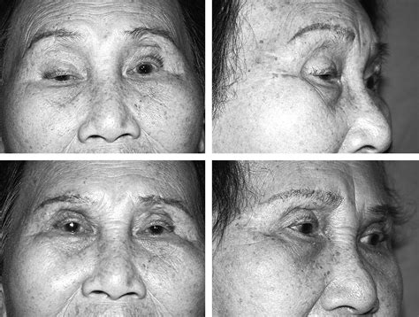 A New Trend For The Treatment Of Blepharoptosis Frontalis Orbicularis