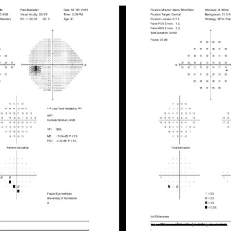Humphrey Visual Field Test Results Can Be Used Over Time To Assess For