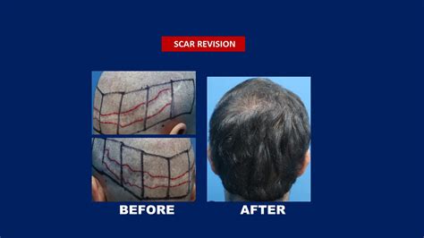 Hair Transplant Scar Revision Before And After