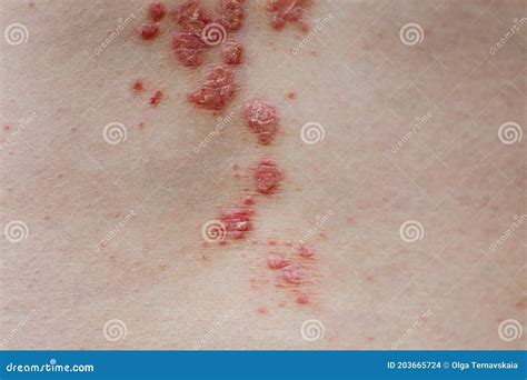 Psoriasis Vulgaris Skin Psoriasis Is An Autoimmune Disease That